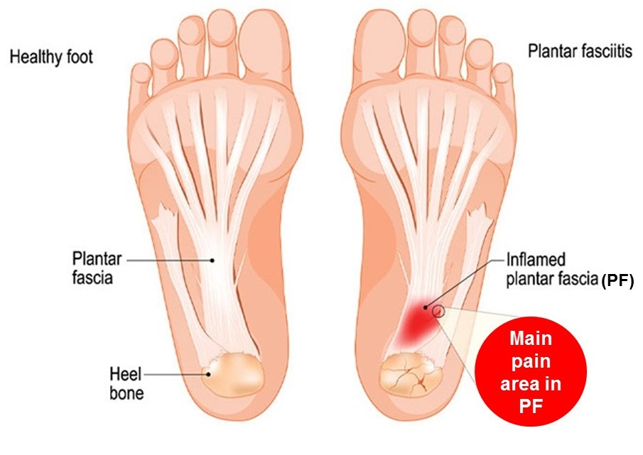 Illustration of the bottom of a normal foot vs plantar fasciitis foot